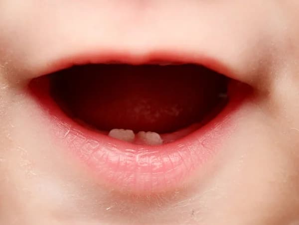 Çocuğumun Ön Dişleri Üst Üste Bindi Ne Yapmalıyım?