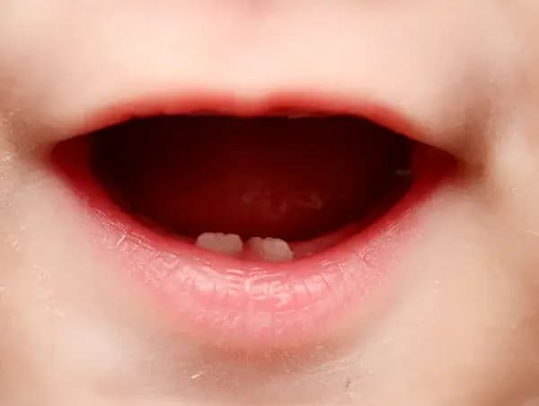 Çocuğumun Ön Dişleri Üst Üste Bindi Ne Yapmalıyım?